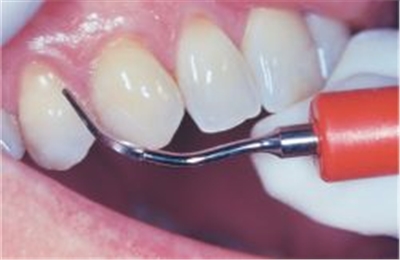 Zähne Skalierung und Polieren